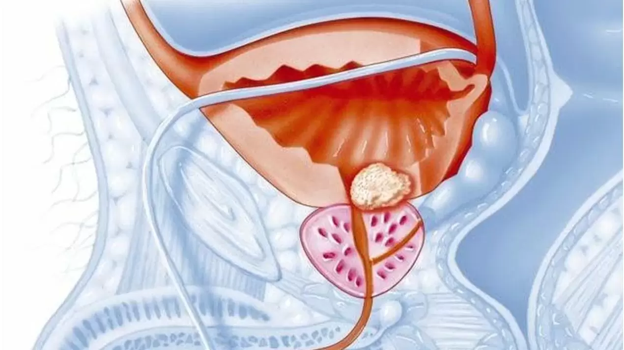 prostatas slimība vīriešiem